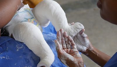 A child's legs in plaster receiving treatment. Cover Image