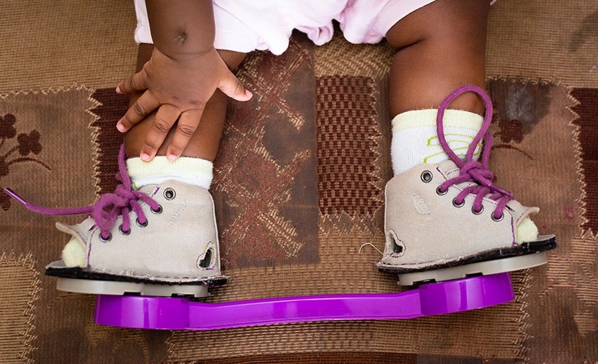 A child with clubfoot using AT