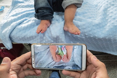 phone showing a babies clubfoot, child above with straight feet after treatment