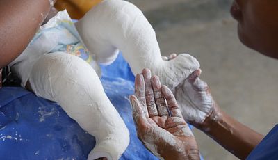 A child's legs in plaster receiving treatment for clubfoot